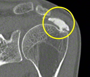 初診時の石灰沈着性腱板炎のコンピューター断層撮影（ＣＴ）画像（丸印で示した部分）