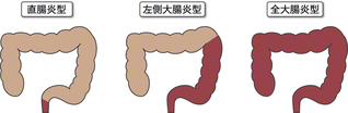 潰瘍性大腸炎のタイプ（罹患範囲）